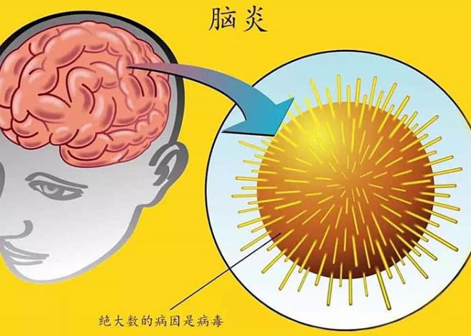 脑炎最新研究进展与治疗方法